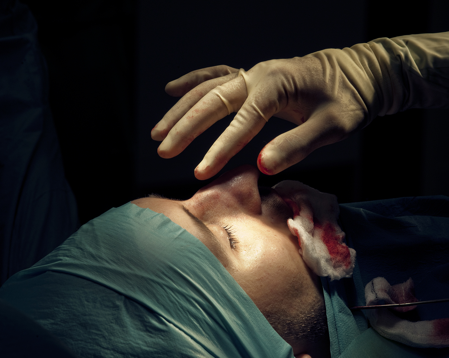 Nose job (rhinoplasty) surgery. James, 25, a British driving instructor, receives a 'nose-job' (Rhinoplasty surgery), to reduced the size of his nose for cosmetic reasons.